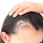 Woman hair loss problem