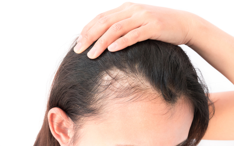 Woman hair loss problem